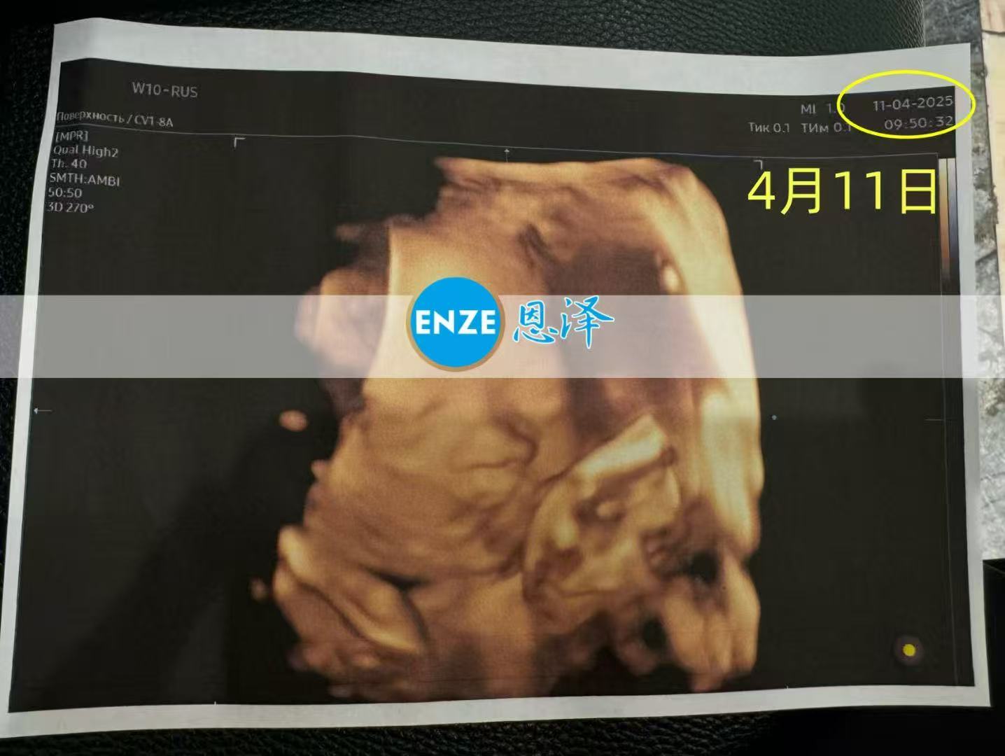格鲁吉亚试管婴儿助孕爱心使者28周产检顺利通过