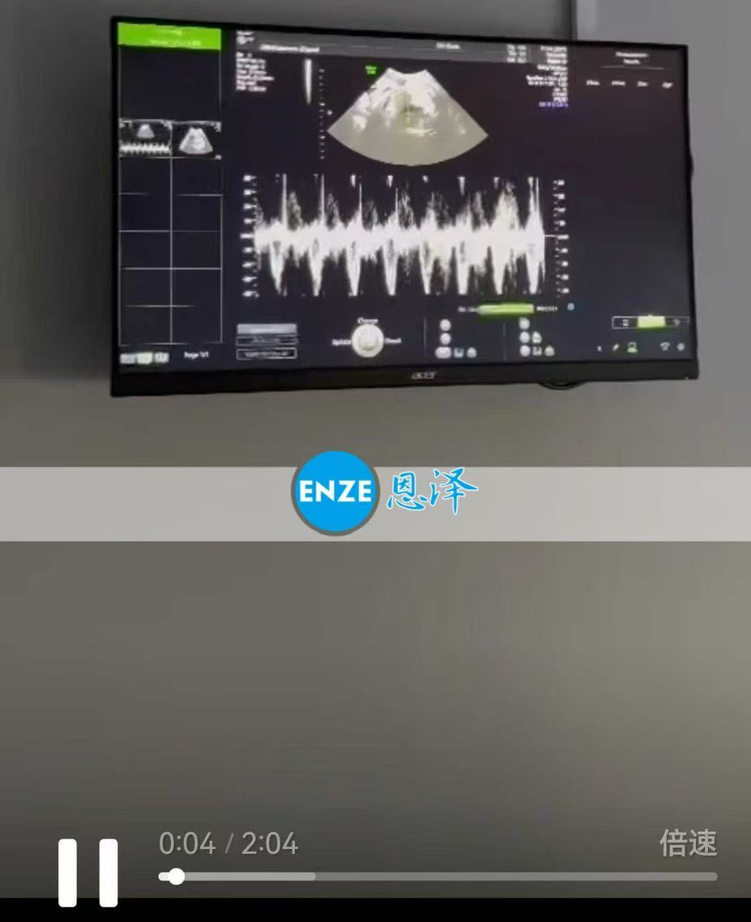 格鲁吉亚试管婴儿助孕爱心使者34周产检顺利通过