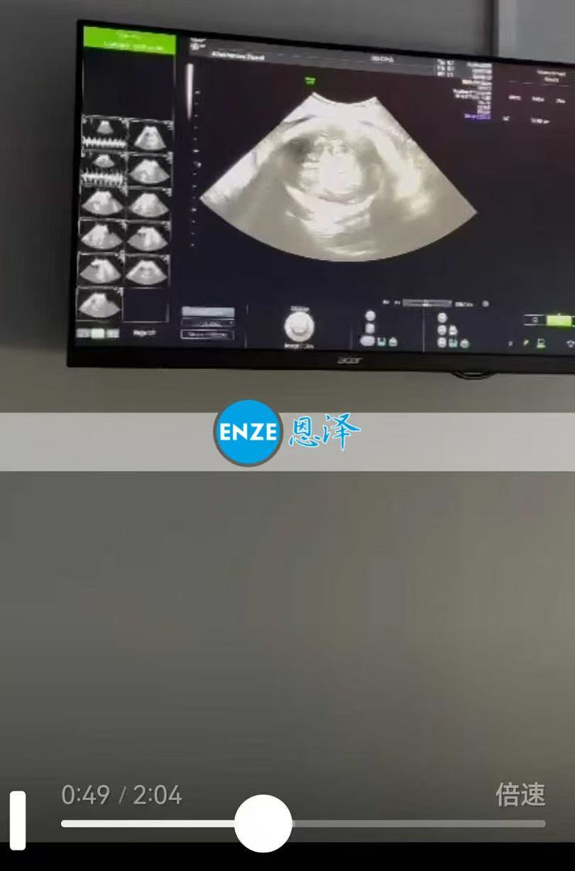 格鲁吉亚试管婴儿助孕爱心使者34周产检顺利通过