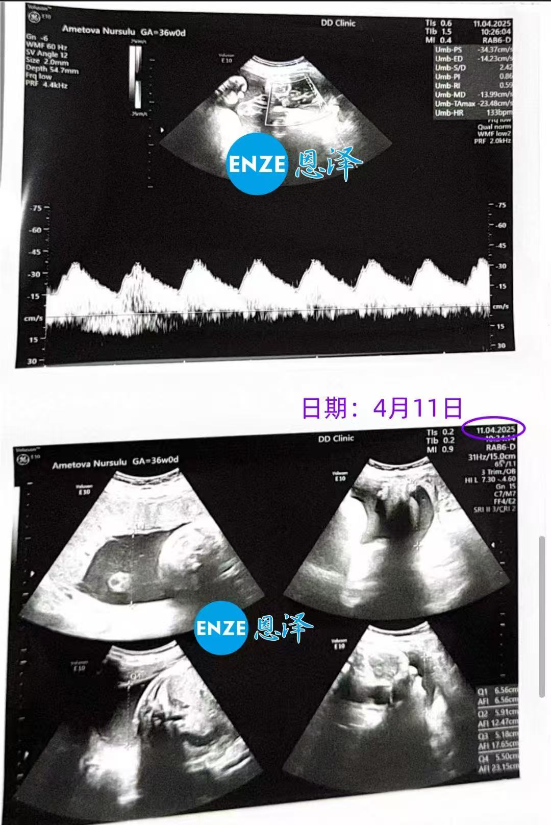 格鲁吉亚试管婴儿助孕爱心使者36周产检通过，即将待产