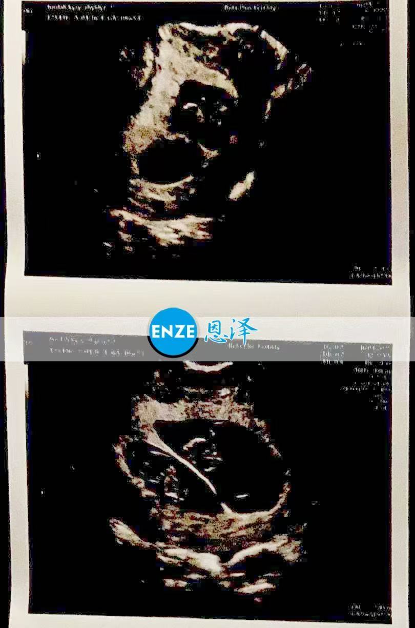 格鲁吉亚试管婴儿助孕爱心使者8周产检顺利通过