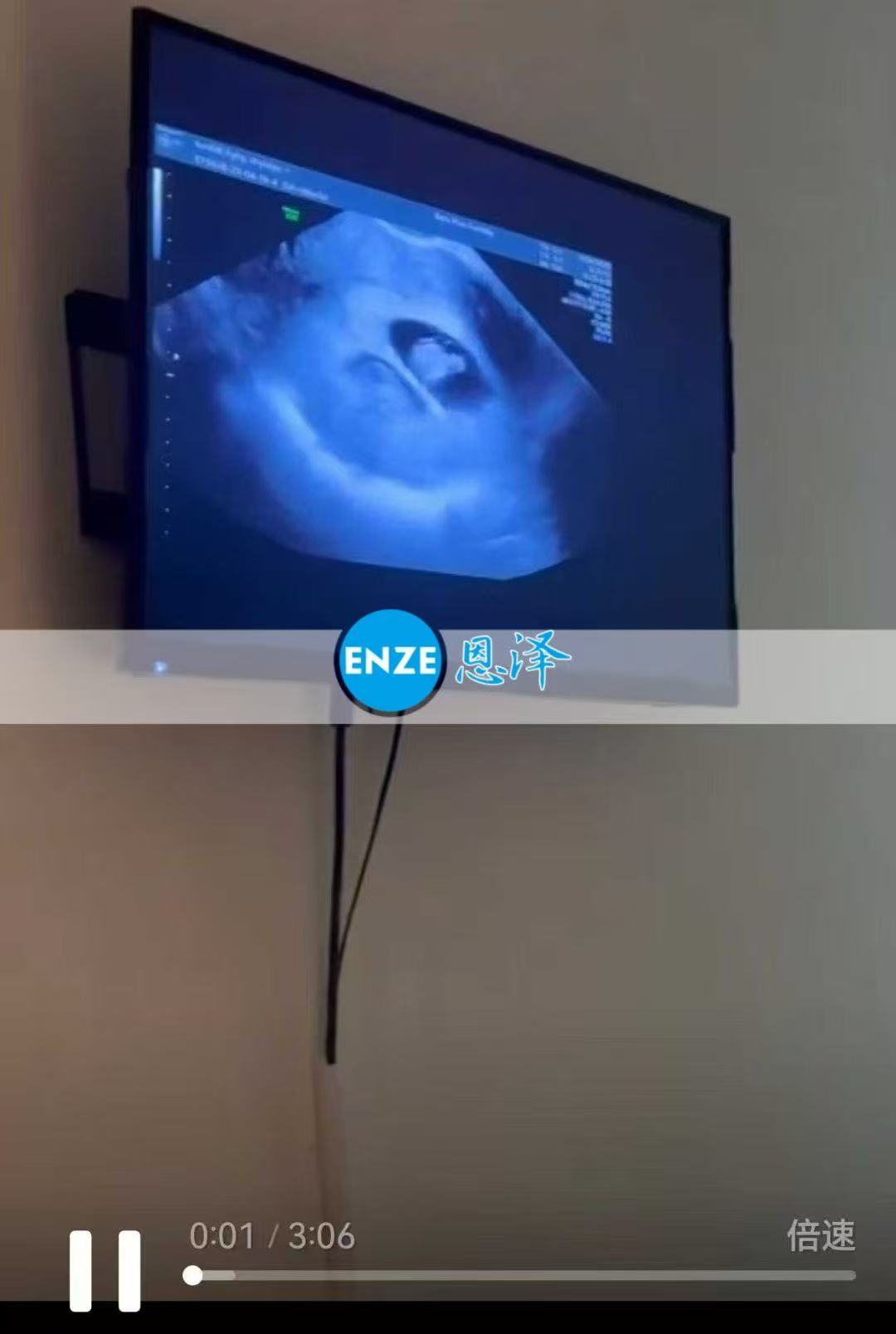 格鲁吉亚试管婴儿助孕爱心使者8周产检顺利通过