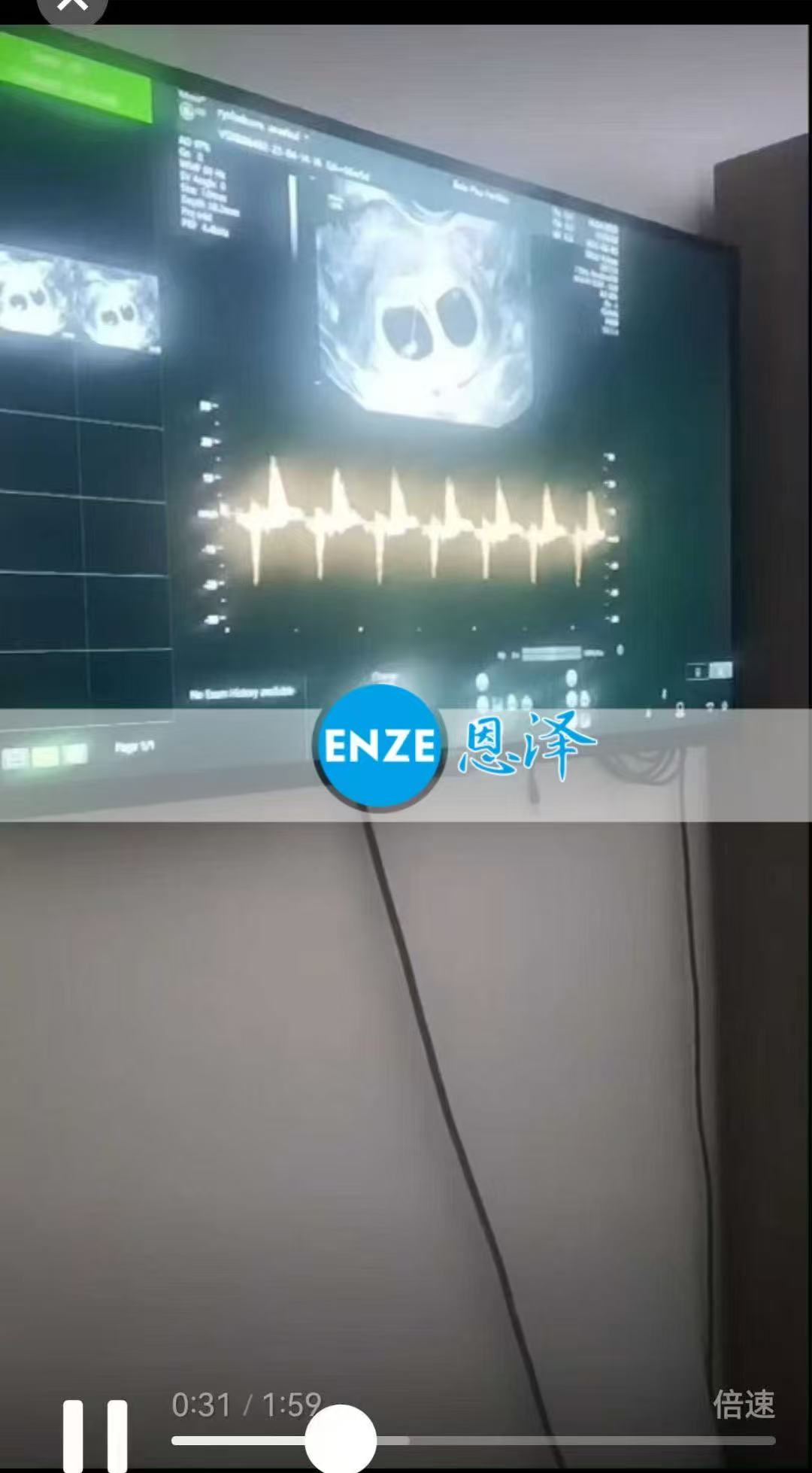 格鲁吉亚试管婴儿助孕爱心使者成功怀上双胎