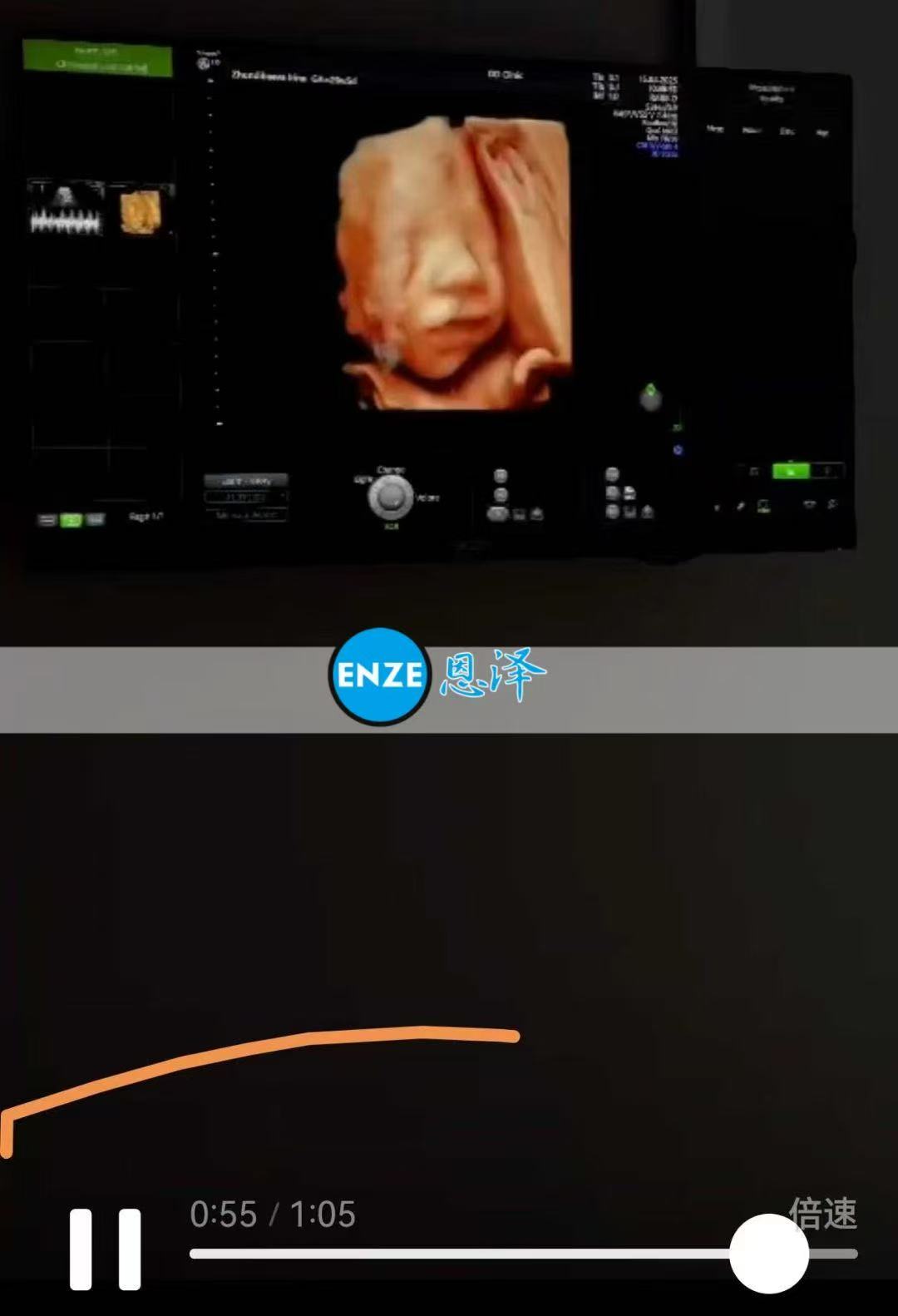格鲁吉亚试管婴儿助孕爱心使者26周产检顺利通过
