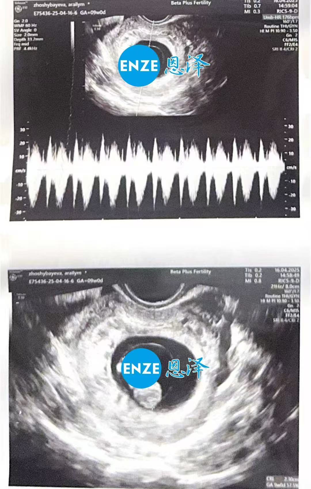 格鲁吉亚试管婴儿助孕爱心使者首次产检顺利过关