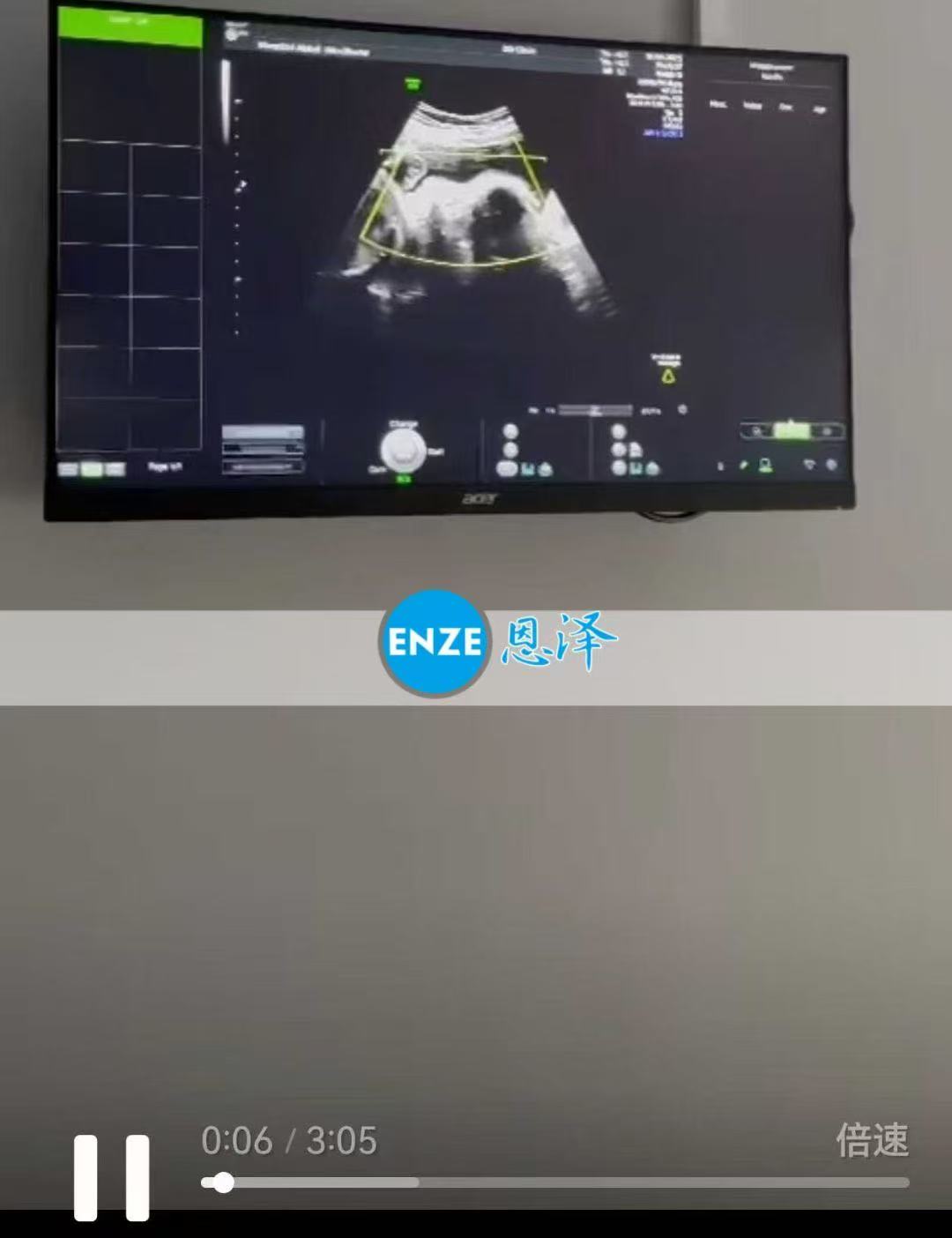 格鲁吉亚试管婴儿助孕爱心使者28周产检顺利通过