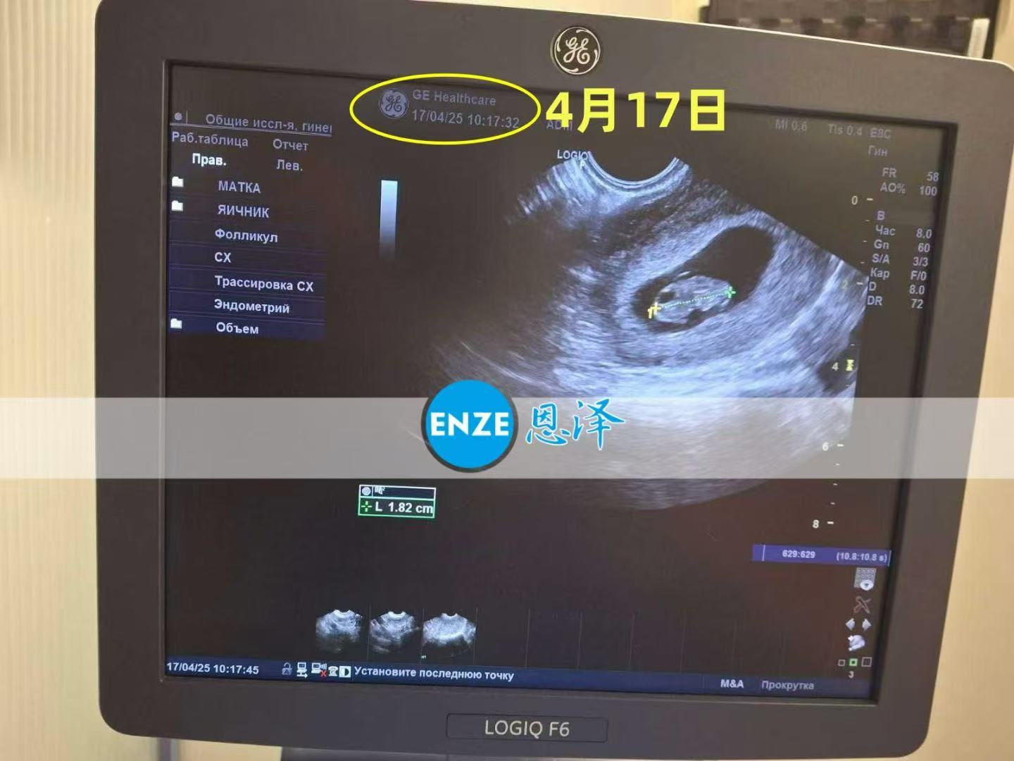 乌克兰试管婴儿助孕爱心使者8周产检顺利通过