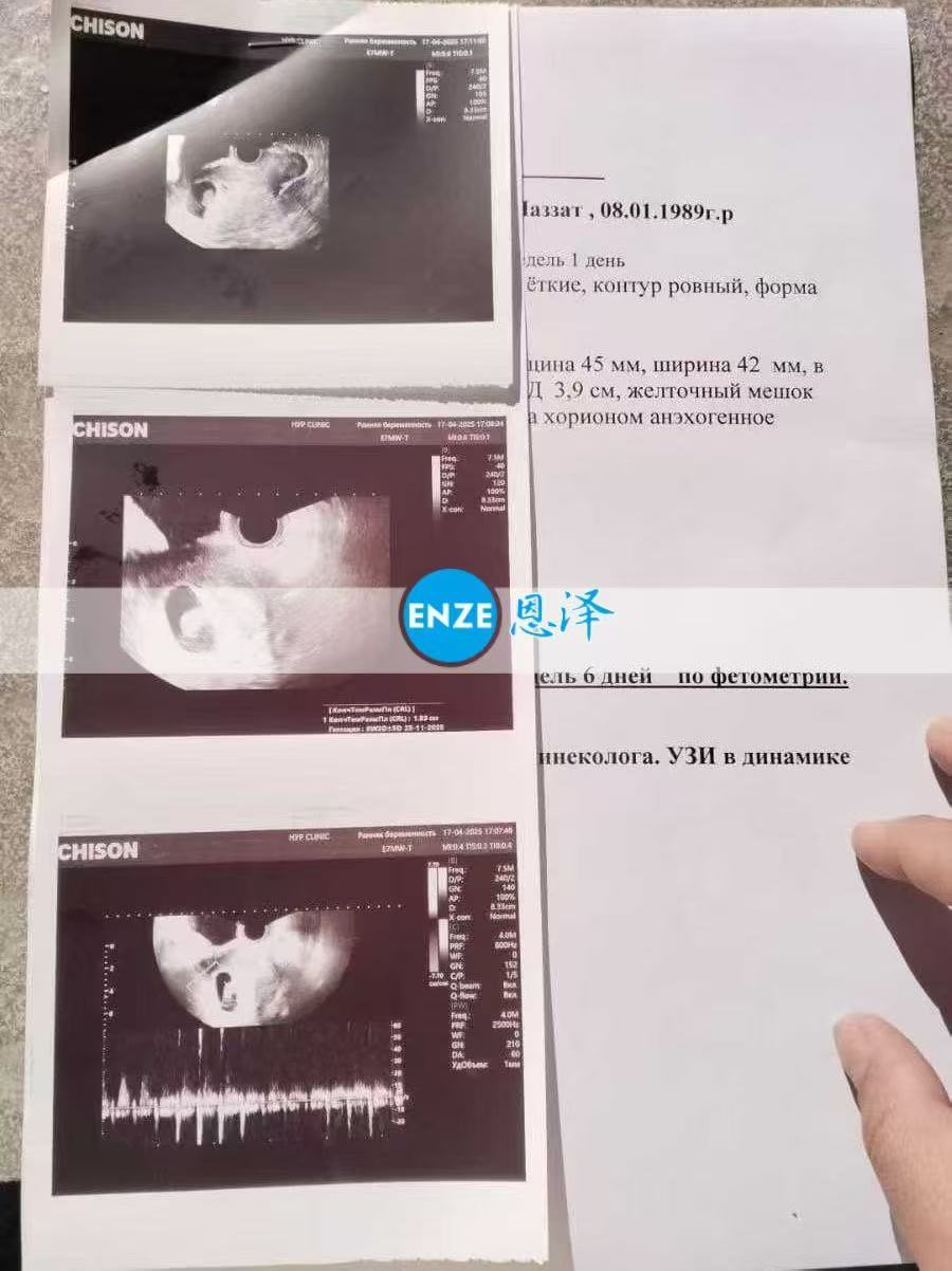 格鲁吉亚试管婴儿助孕爱心使者8周产检顺利过关