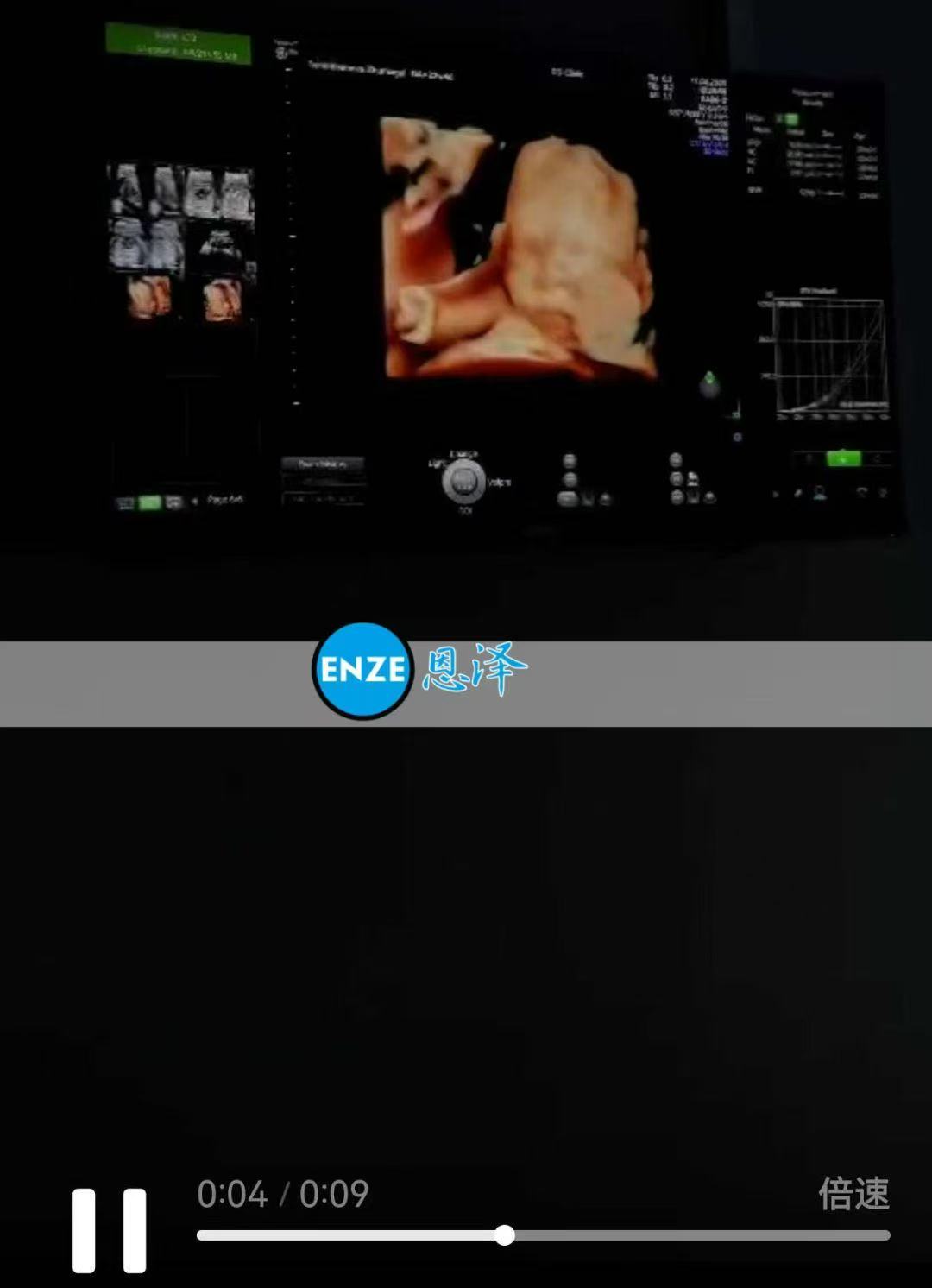 格鲁吉亚试管婴儿助孕爱心使者双胎22周产检顺利通过