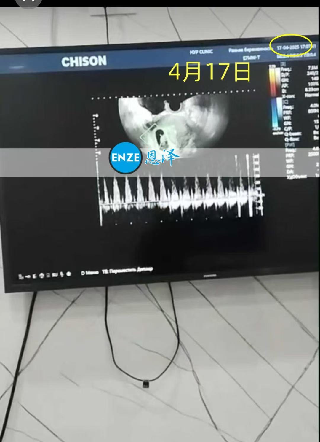 格鲁吉亚试管婴儿助孕爱心使者8周产检顺利过关