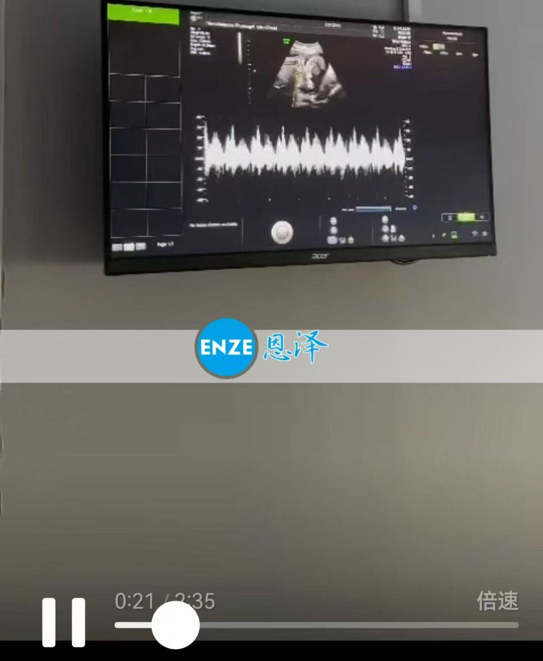 格鲁吉亚试管婴儿助孕爱心使者双胎22周产检顺利通过