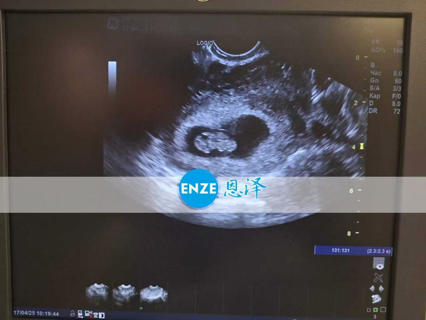 乌克兰试管婴儿助孕爱心使者8周产检顺利通过