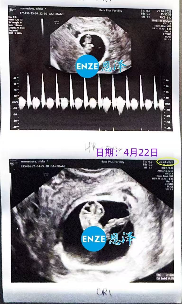 格鲁吉亚试管婴儿助孕爱心使者8周产检顺利过关
