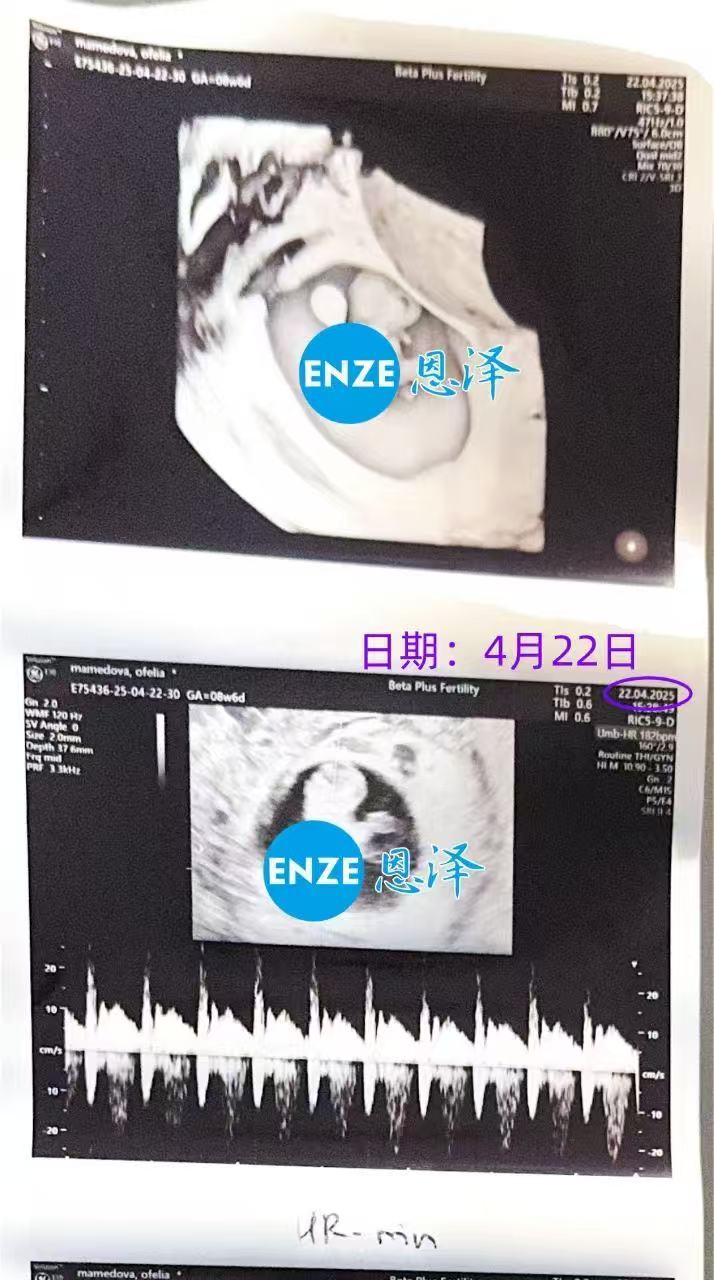 格鲁吉亚试管婴儿助孕爱心使者8周产检顺利过关
