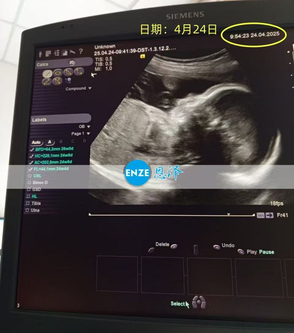乌克兰试管婴儿助孕爱心使者20周产检顺利通过