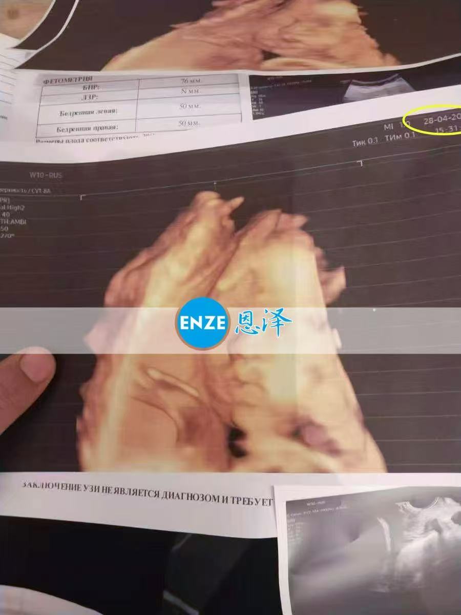 哈萨克斯坦试管婴儿助孕爱心使者成功通过29周产检