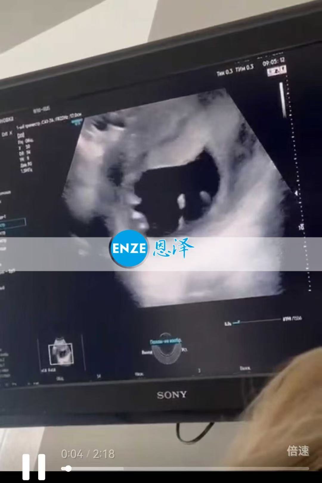哈萨克斯坦试管婴儿助孕爱心使者12周产检顺利过关