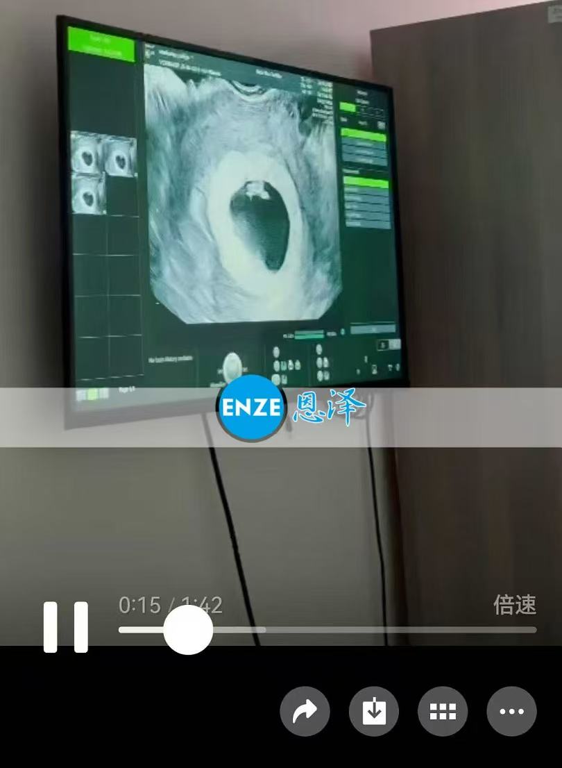 格鲁吉亚试管婴儿助孕爱心使者6周首检顺利通过
