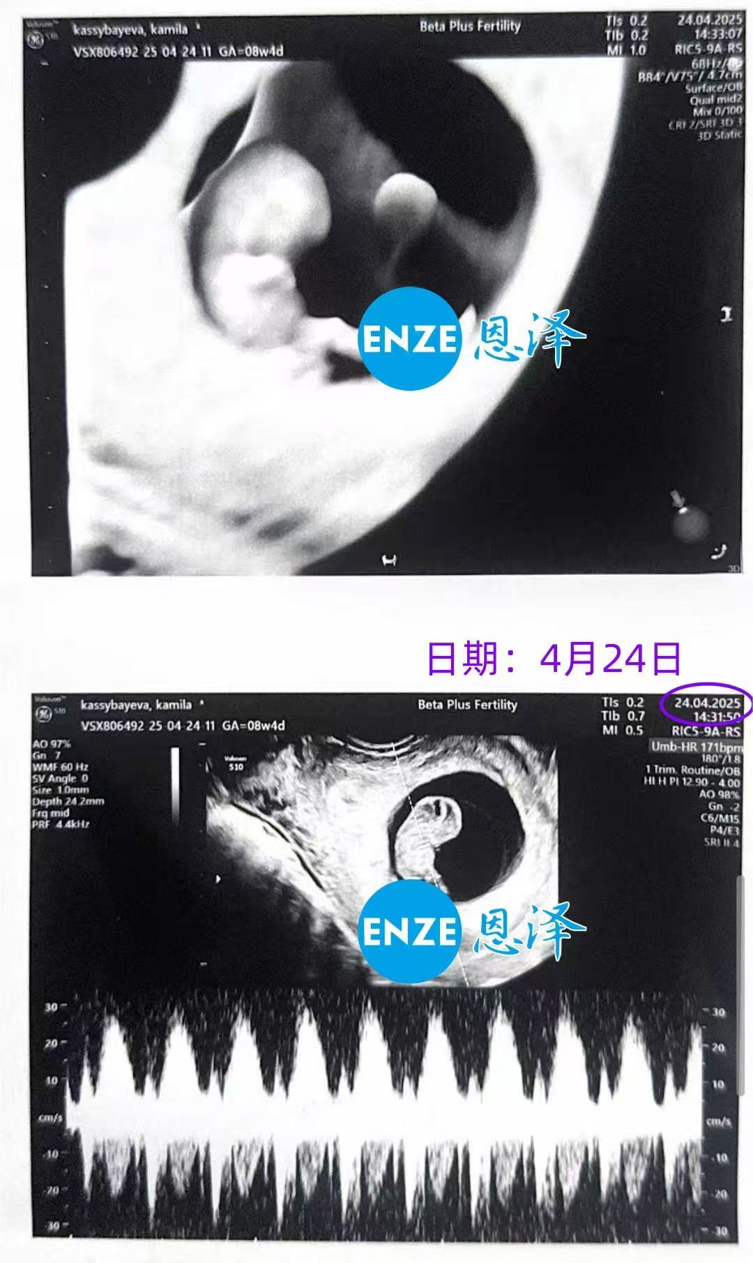 格鲁吉亚试管婴儿助孕爱心使者8周产检顺利通过