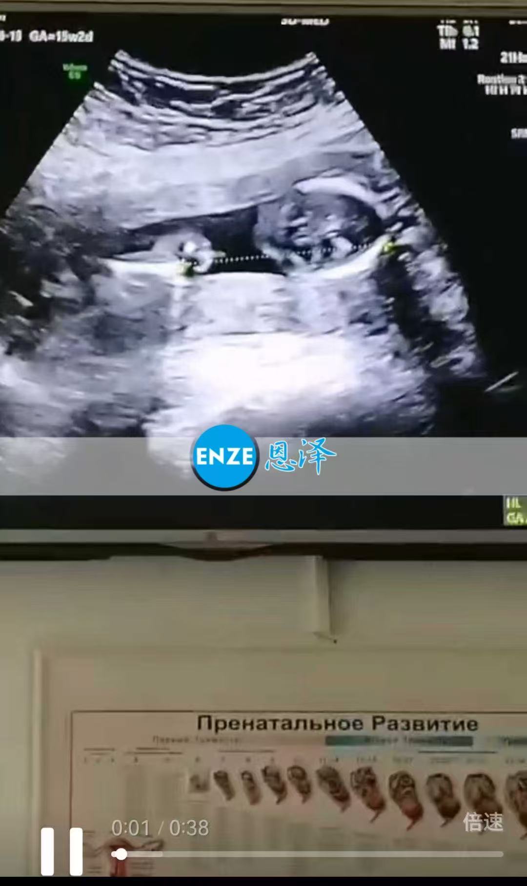 格鲁吉亚试管婴儿助孕爱心使者15周产检顺利通过