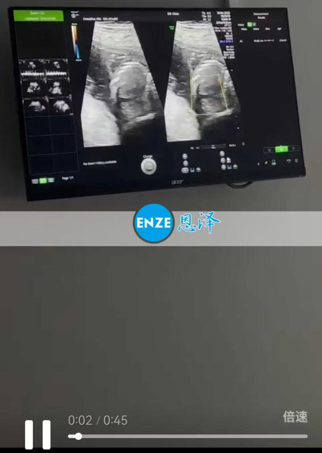 格鲁吉亚试管婴儿助孕双胎爱心使者21周产检过关