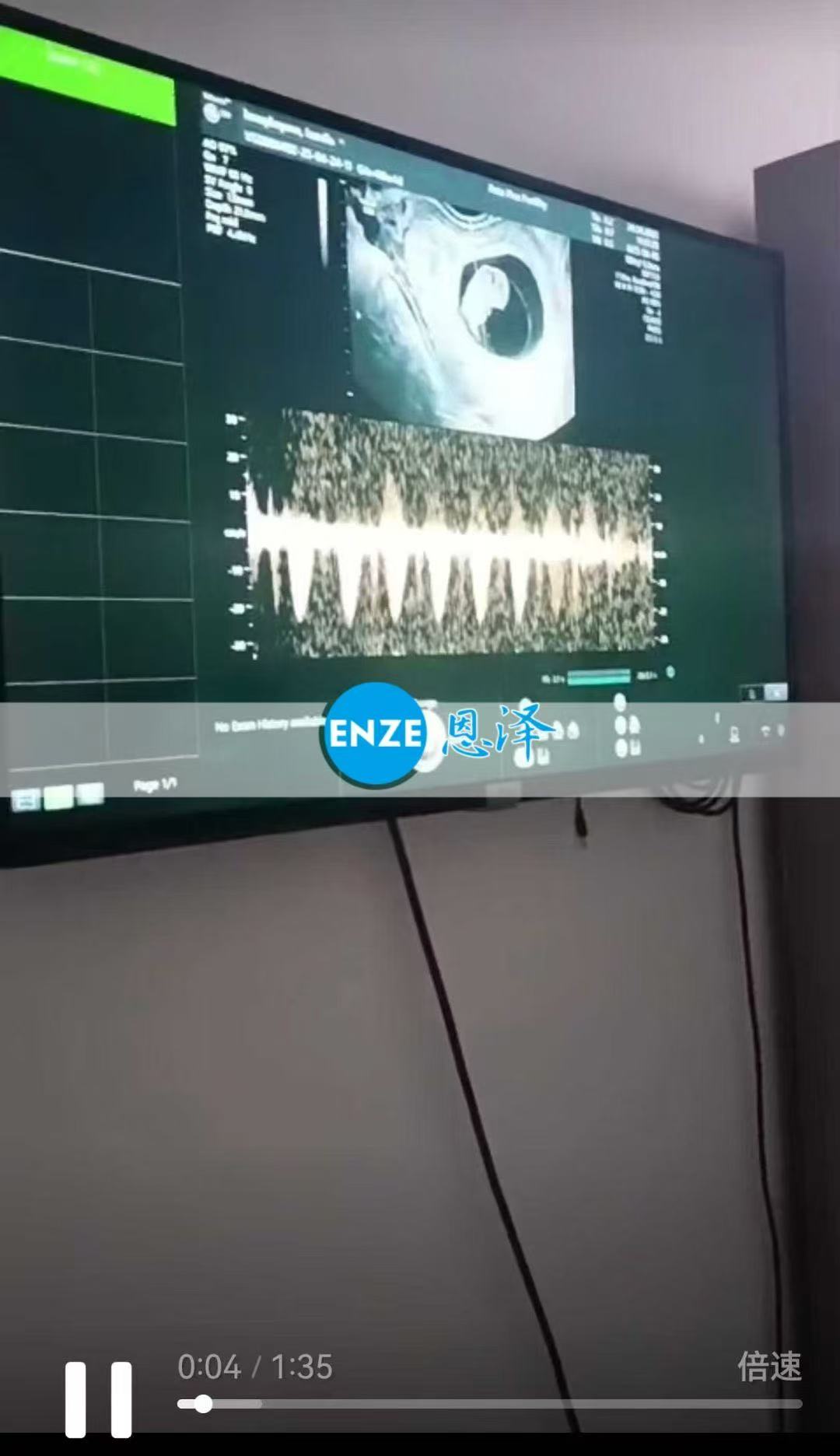 格鲁吉亚试管婴儿助孕爱心使者8周产检顺利通过