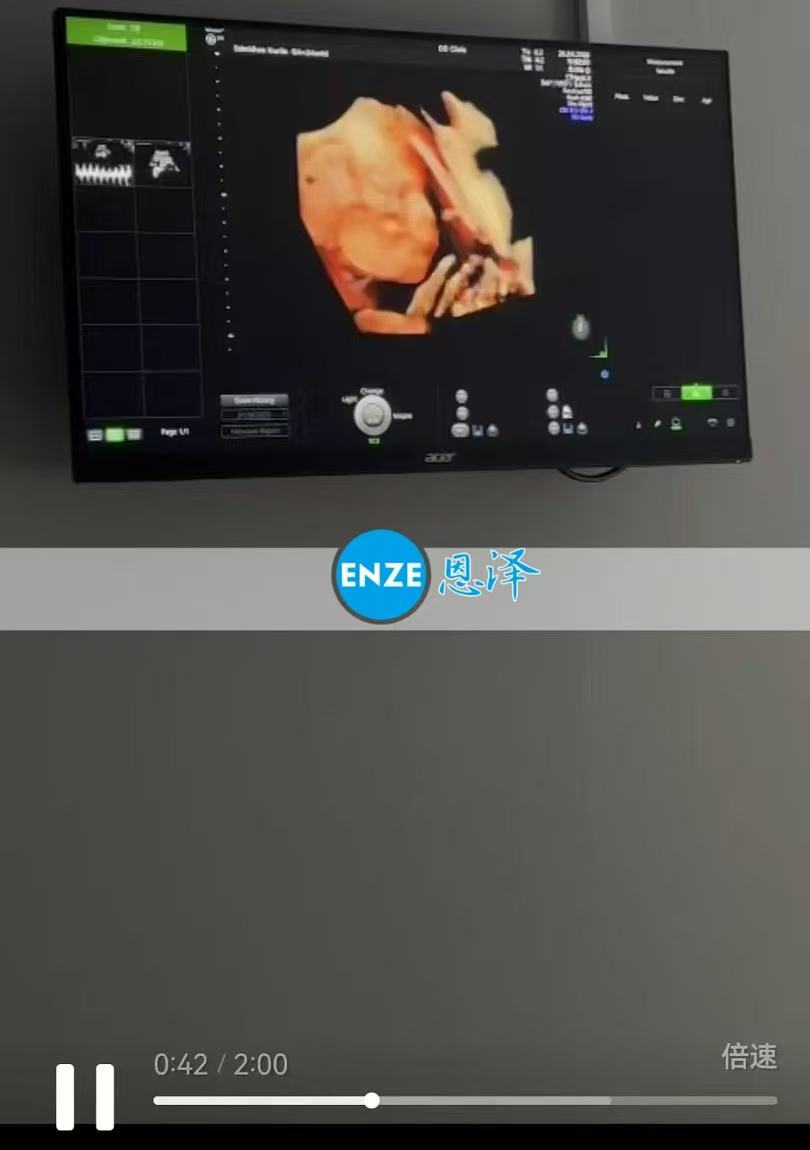 格鲁吉亚试管婴儿助孕爱心使者24周产检顺利通过