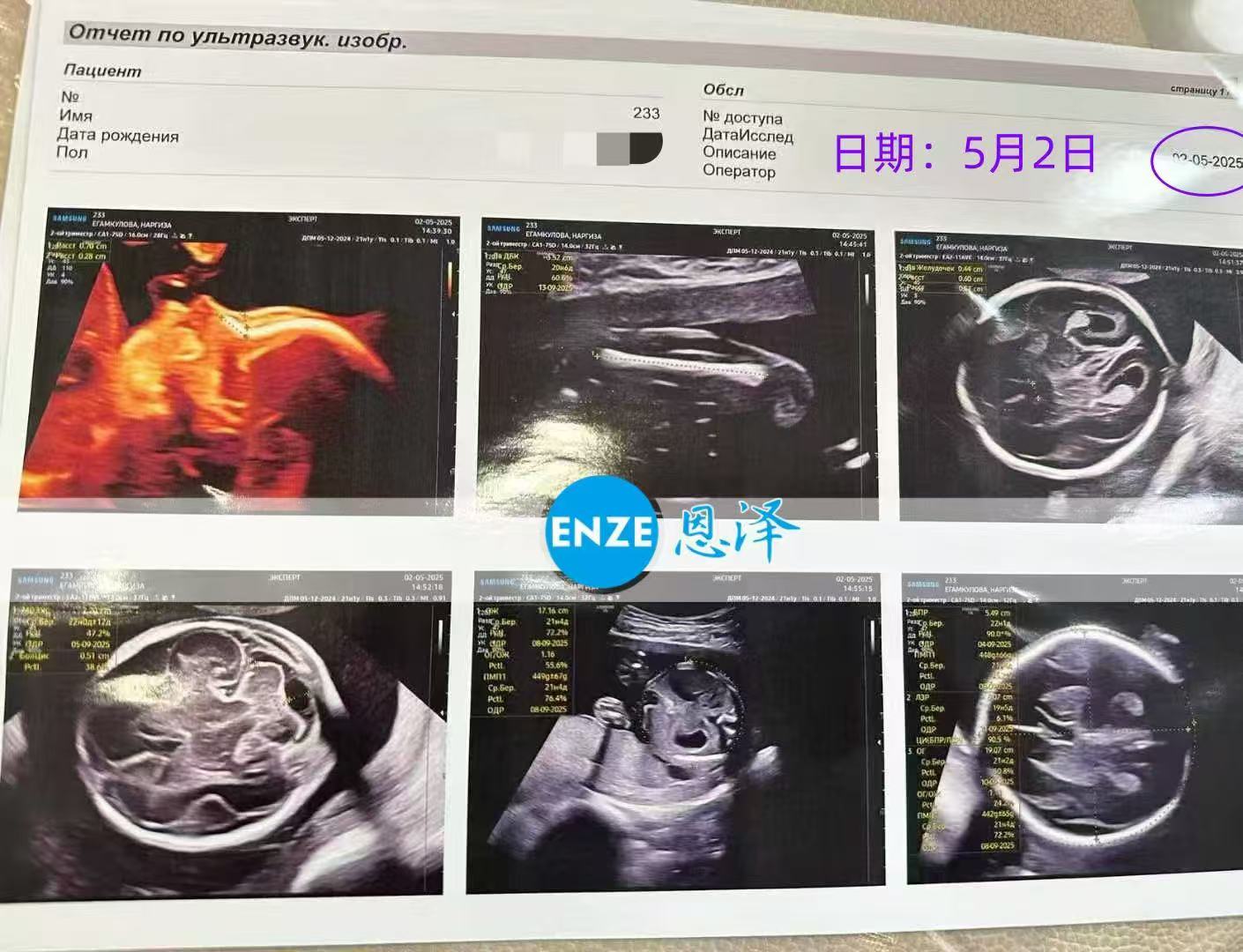 格鲁吉亚试管婴儿助孕爱心使者21周产检顺利通过