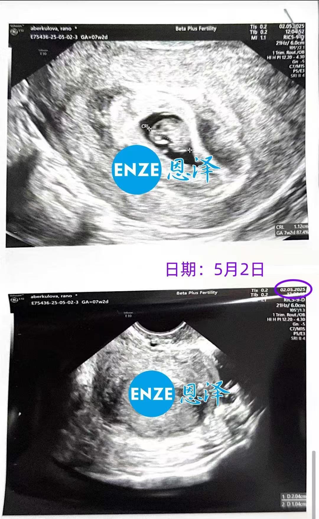 格鲁吉亚试管婴儿助孕爱心使者7周产检顺利通过