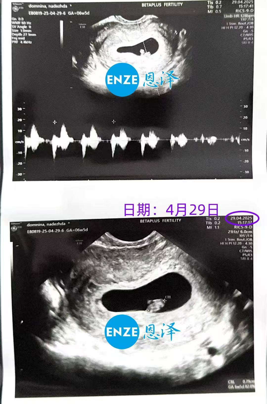 格鲁吉亚试管婴儿助孕爱心使者首次产检顺利通过