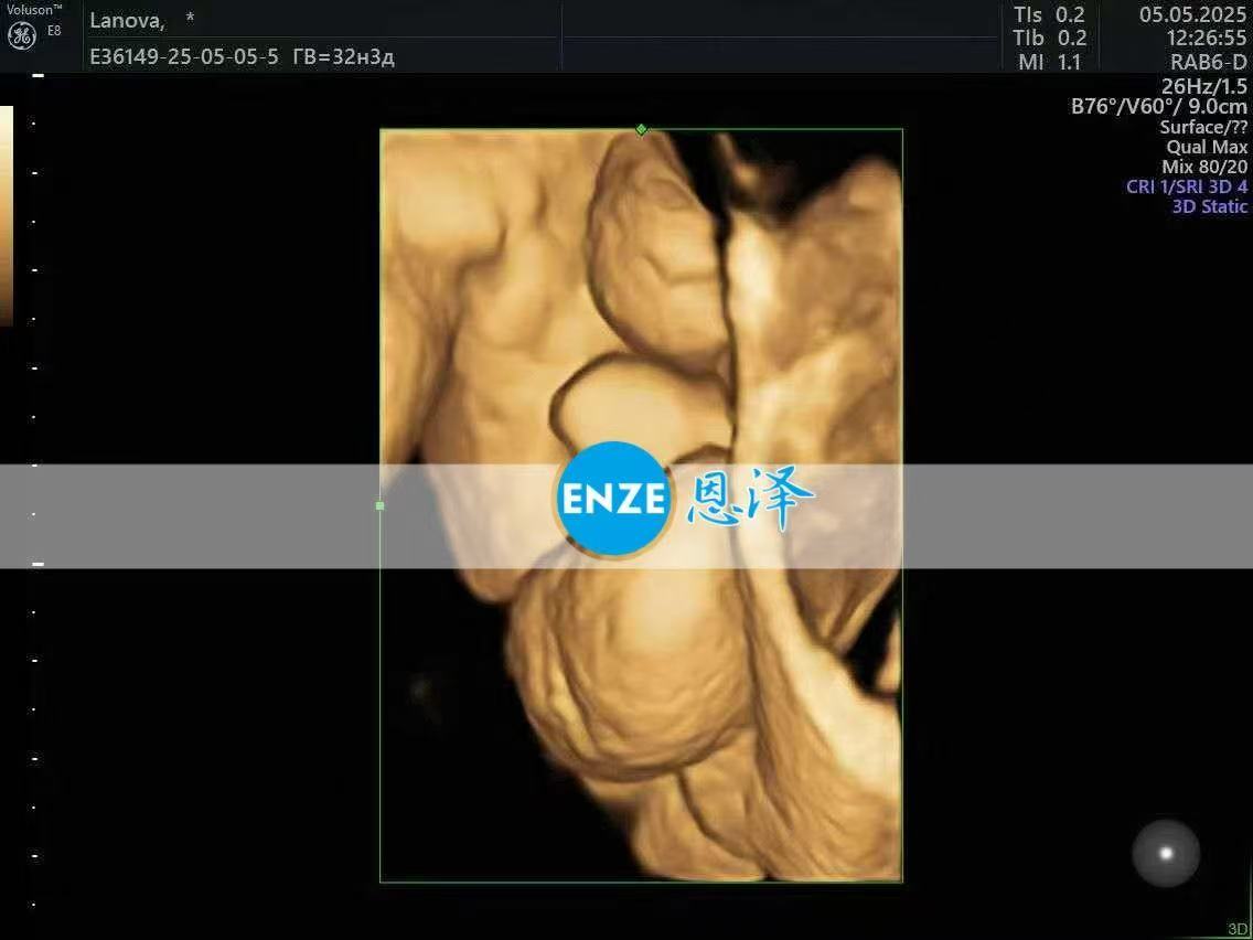 格鲁吉亚试管婴儿助孕爱心使者32周产检顺利通过