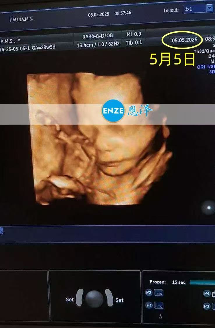乌克兰试管婴儿助孕爱心使者28周检查顺利过关
