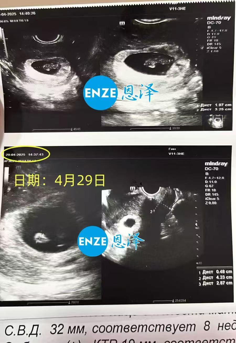 格鲁吉亚试管婴儿助孕爱心使者8周产检顺利过关