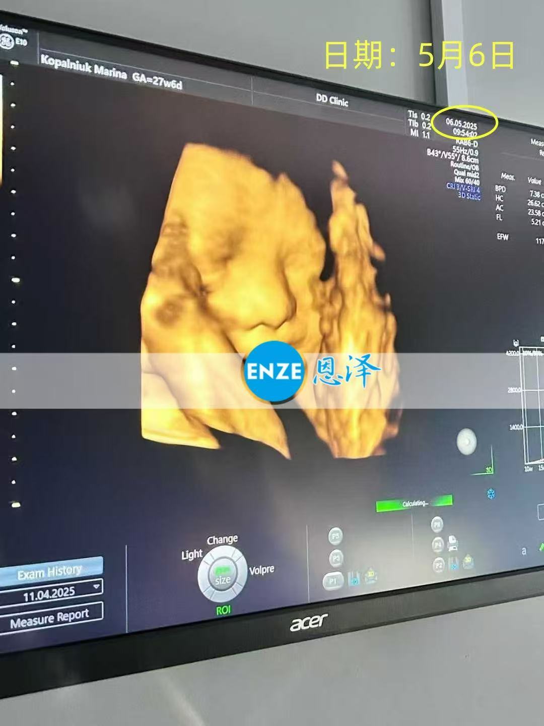 格鲁吉亚试管婴儿助孕爱心使者27周产检顺利通过