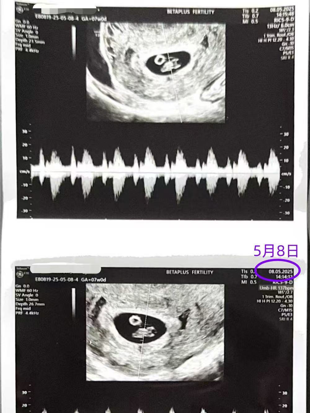 格鲁吉亚试管婴儿助孕爱心使者成功通过7周产检
