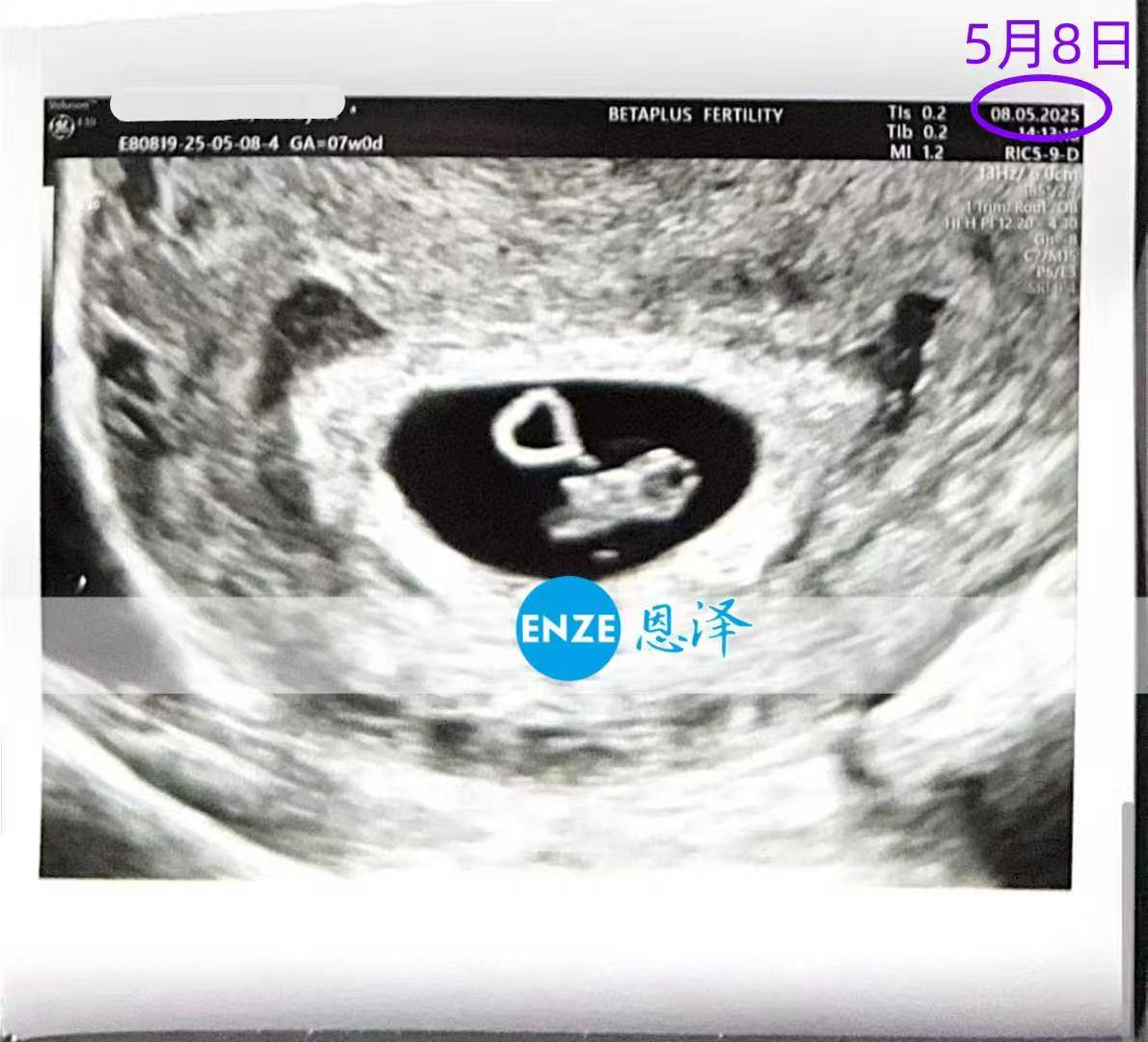格鲁吉亚试管婴儿助孕爱心使者成功通过7周产检