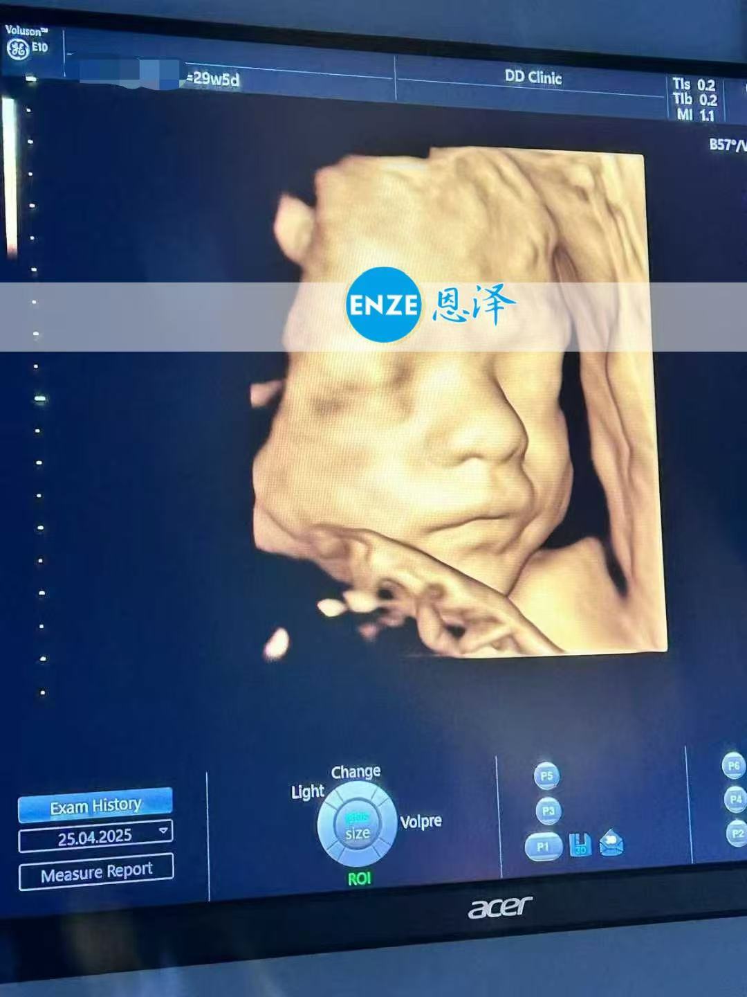 格鲁吉亚试管婴儿助孕爱心使者29周产检顺利通过