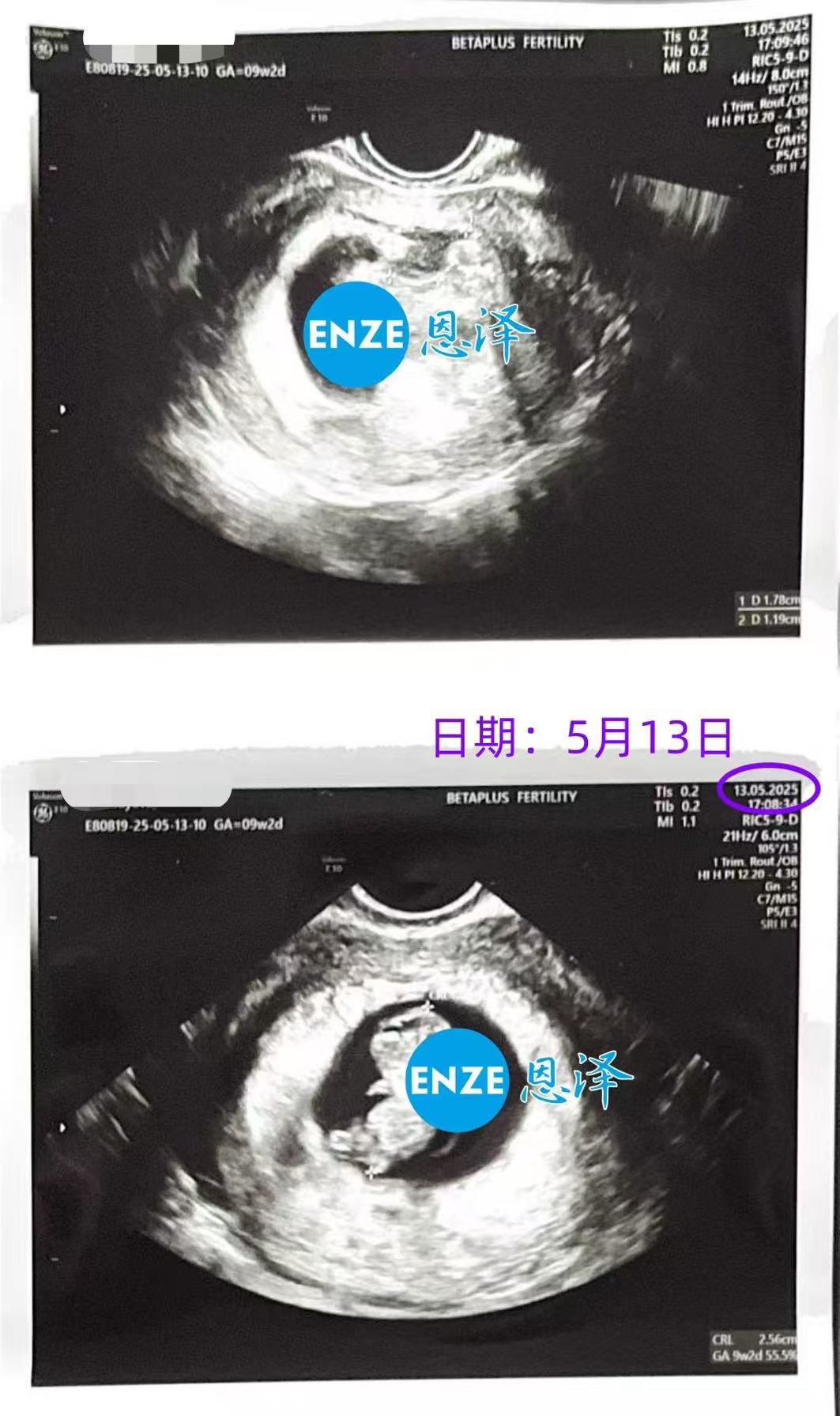 格鲁吉亚试管婴儿助孕爱心使者9周产检顺利过关