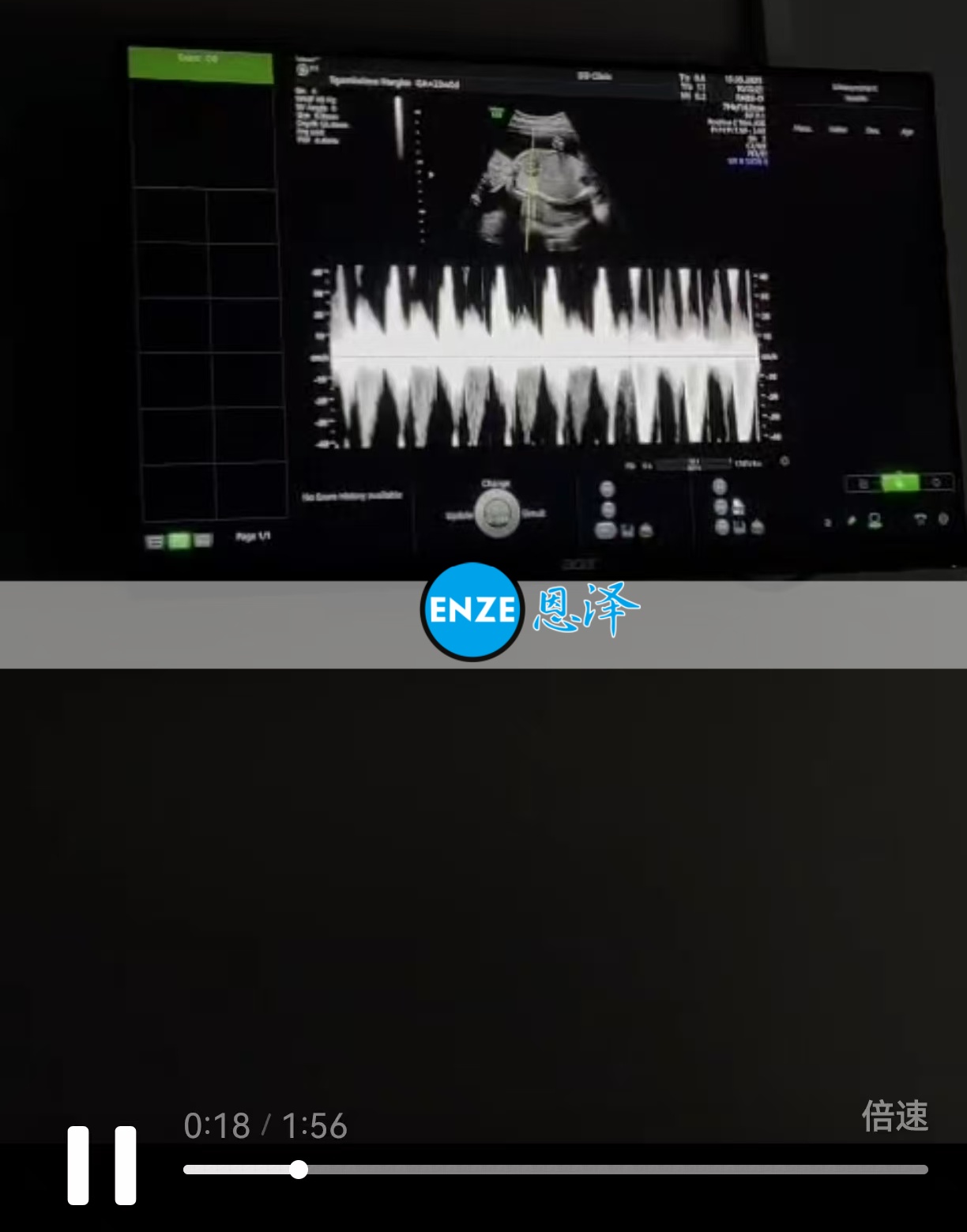 恩泽格鲁吉亚试管婴儿助孕爱心使者23周检查顺利通过