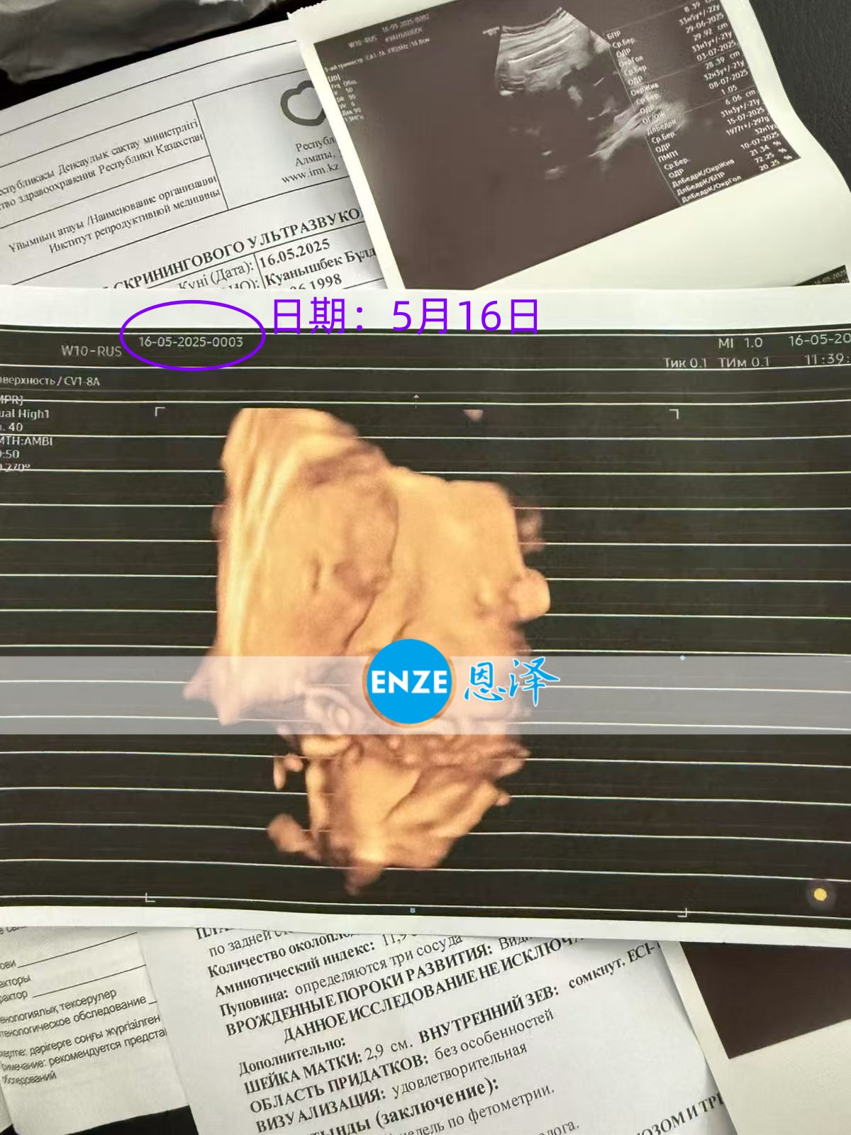 恩泽格鲁吉亚试管婴儿助孕爱心使者32周检查顺利通过